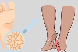 3 bước chăm sóc gót chân trong những ngày hanh khô