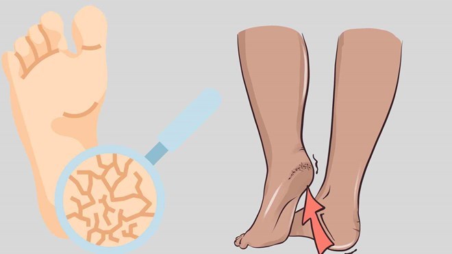 3 bước chăm sóc gót chân trong những ngày hanh khô