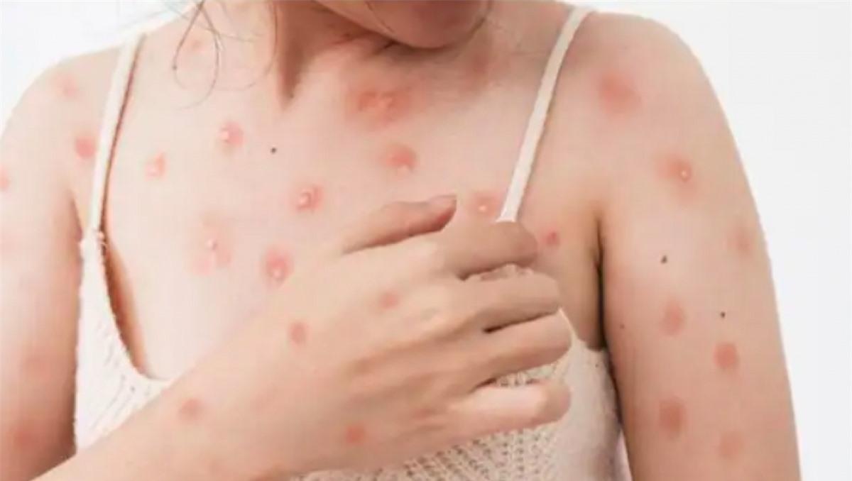 6 loai thuc pham giup phuc hoi sau khi bi benh dau mua khi hinh anh 2