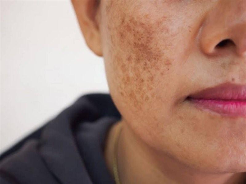 Nguyên nhân và cách điều trị tăng sắc tố da hiệu quả