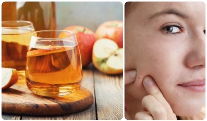 Cách trị mụn ẩn tại nhà hiệu quả sau một đêm - 1