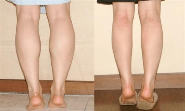 Phương pháp thu nhỏ bắp chân đơn giản nhưng không nhiều người biết