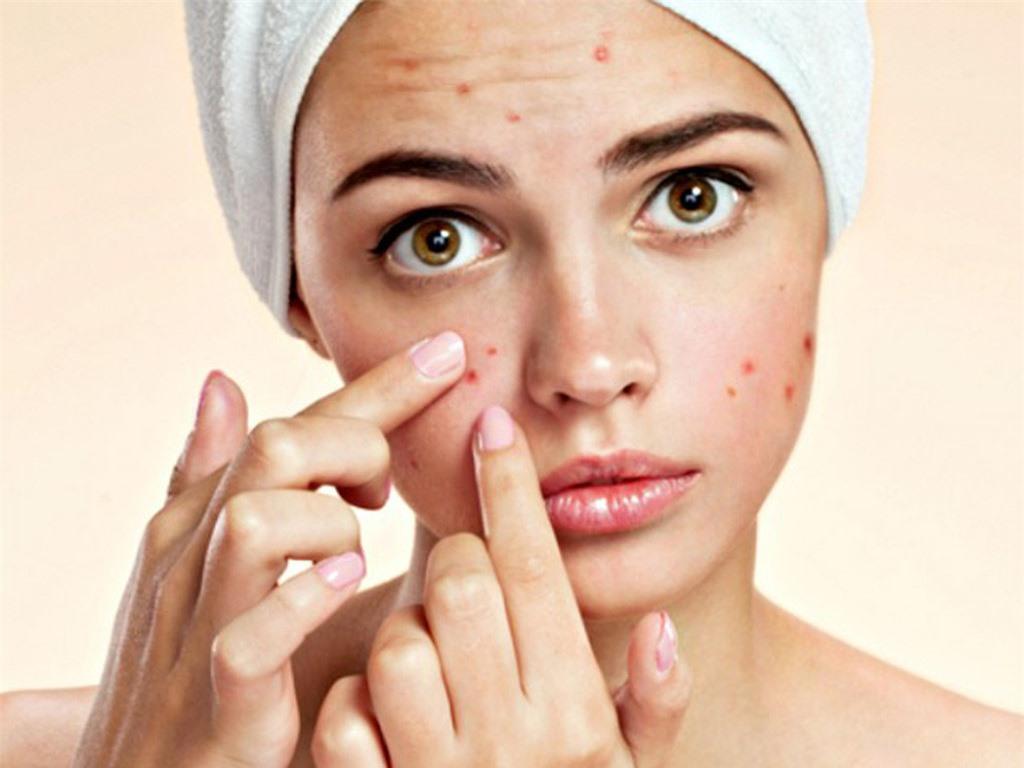 Cách trị mụn cấp tốc và hiệu quả nhất chỉ trong một ngày