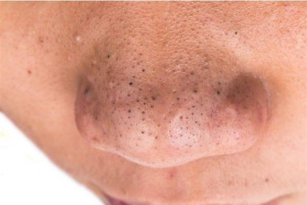 Loại bỏ mụn đầu đen ở mũi hiệu quả tại nhà