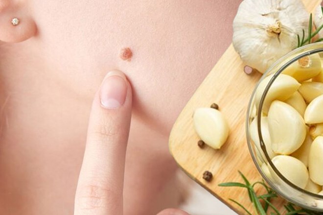 Làm thế nào bạn có thể điều trị mụn cóc tại nhà?