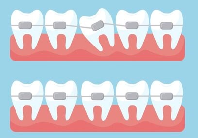 Những lưu ý quan trọng khi niềng răng cho trẻ em