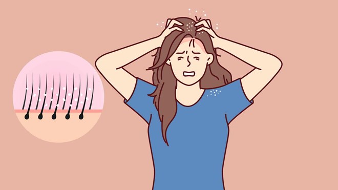 Bí quyết tự nhiên giúp giảm ngứa da đầu