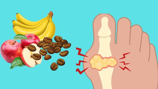7 loại thực phẩm giúp giảm axit uric tự nhiên nếu mắc bệnh gút