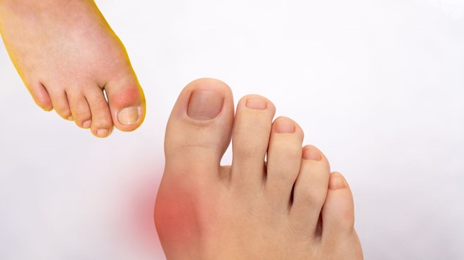 Các thói quen tưởng vô hại nhưng lại khiến axit uric mãi không giảm